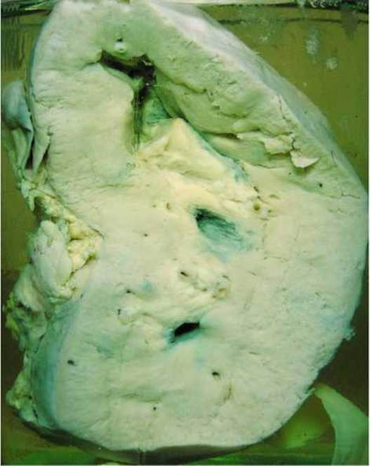 Амілоїдоз нирок (біла нирка)