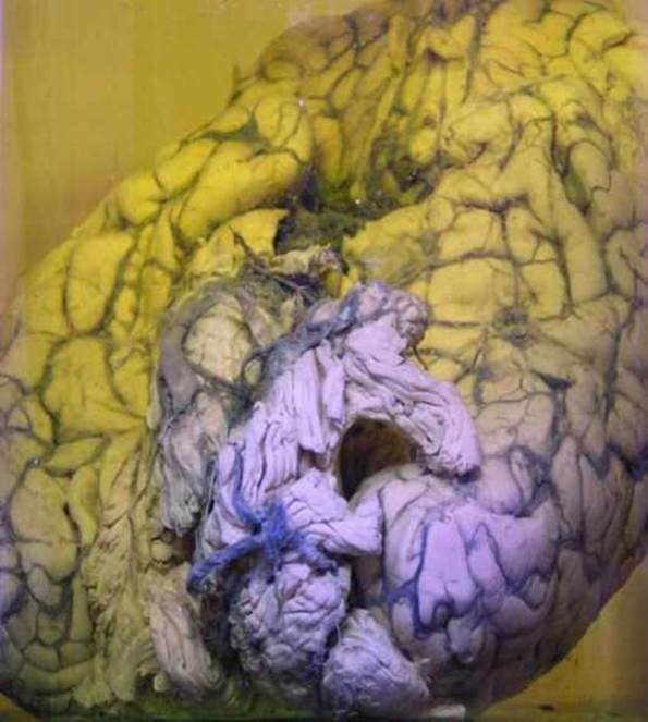 Крововилив у головний мозок
